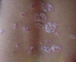 牛皮癣10 牛皮癣10